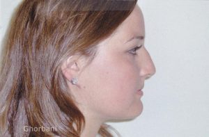 Rhinoplasty