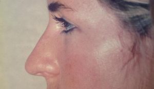 Rhinoplasty