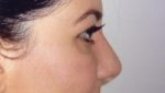 Rhinoplasty