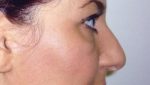 Rhinoplasty