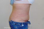 Abdominoplasty