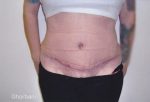 Abdominoplasty