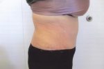 Abdominoplasty