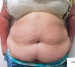 Abdominoplasty