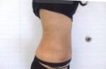 Abdominoplasty