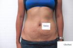 Abdominoplasty