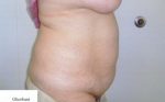 Abdominoplasty