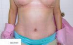 Abdominoplasty