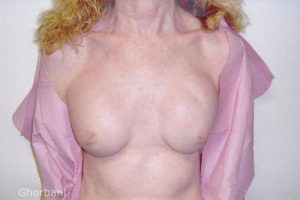 Breast Augmentation Using Implants