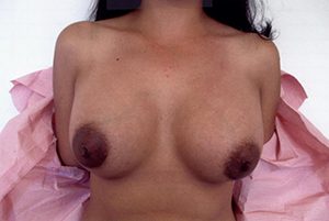 Breast Augmentation Using Implants