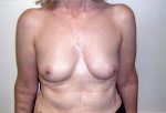 Bilateral Breast and Nipple-Areola Reconstruction