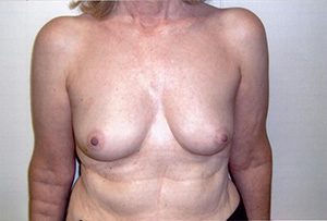 Bilateral Breast and Nipple-Areola Reconstruction