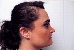 Rhinoplasty Case 2780 Before Photo Rhinoplasty