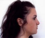 Rhinoplasty