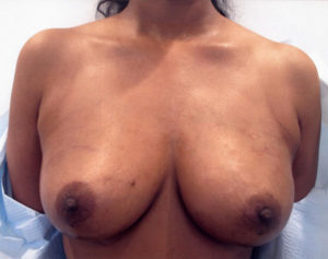 Breast Augmentation Using Fat Grafting (Transfer)