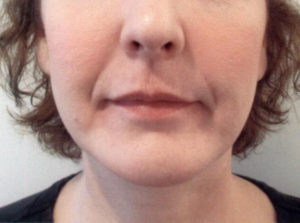 Chin and Jawline Contouring