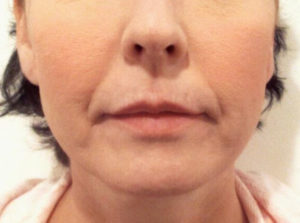Chin and Jawline Contouring