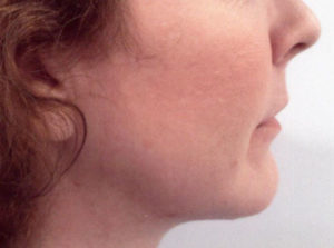 Chin and Jawline Contouring