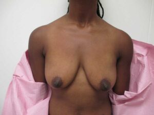 Breast Augmentation Using Implants Case 4818 Before Photo Breast Augmentation Using Implants