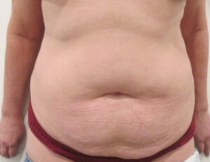 Abdominoplasty