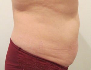 Abdominoplasty