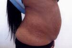 Abdominoplasty