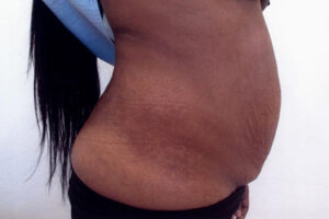Abdominoplasty