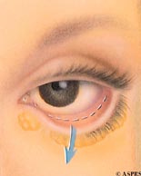 Blepharoplasty in the San Francisco Bay Area