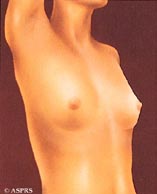 Breast Enlargement Before Image