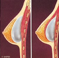Breast Enlargement Procedure