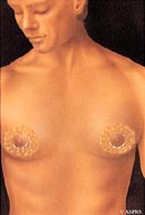 Danville male breast reduction